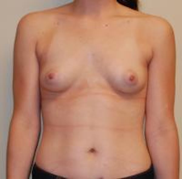 Breast Augmentation Before & After Gallery - Patient 22391252 - Image 1