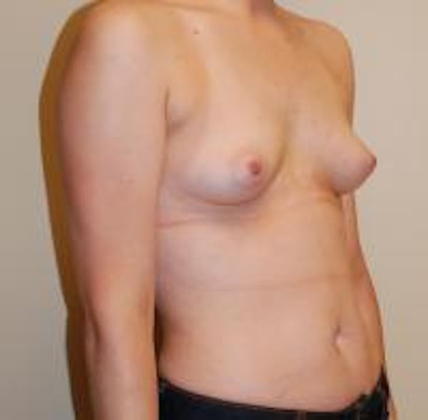 Breast Augmentation Before & After Gallery - Patient 22391252 - Image 3