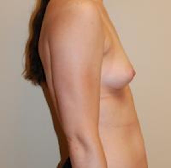 Breast Augmentation Before & After Gallery - Patient 22391252 - Image 7