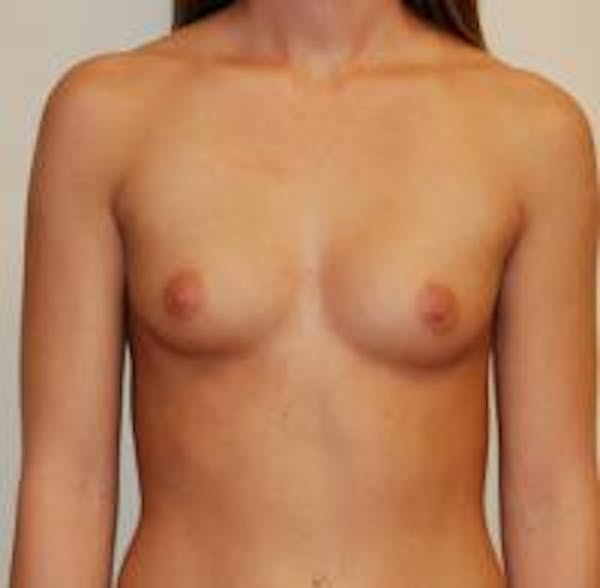 Breast Augmentation Before & After Gallery - Patient 22391253 - Image 1