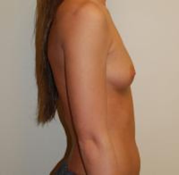 Breast Augmentation Before & After Gallery - Patient 22391253 - Image 3