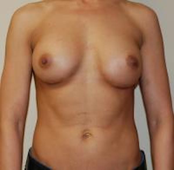 Breast Augmentation Before & After Gallery - Patient 22391254 - Image 2