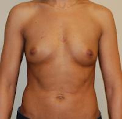 Breast Augmentation Before & After Gallery - Patient 22391254 - Image 1