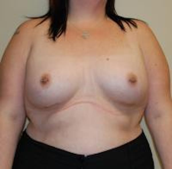 Breast Augmentation Before & After Gallery - Patient 22391255 - Image 2