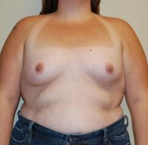 Breast Augmentation Before & After Gallery - Patient 22391255 - Image 1