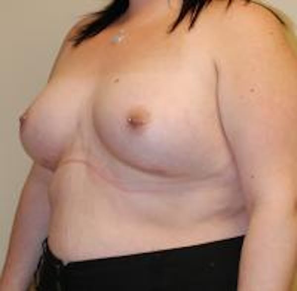 Breast Augmentation Before & After Gallery - Patient 22391255 - Image 4