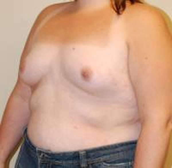 Breast Augmentation Before & After Gallery - Patient 22391255 - Image 3