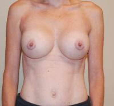 Breast Augmentation Before & After Gallery - Patient 22391256 - Image 2