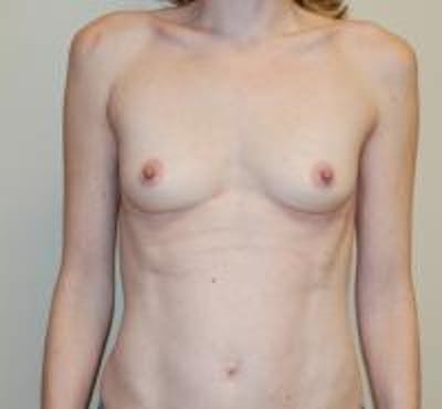 Breast Augmentation Before & After Gallery - Patient 22391256 - Image 1