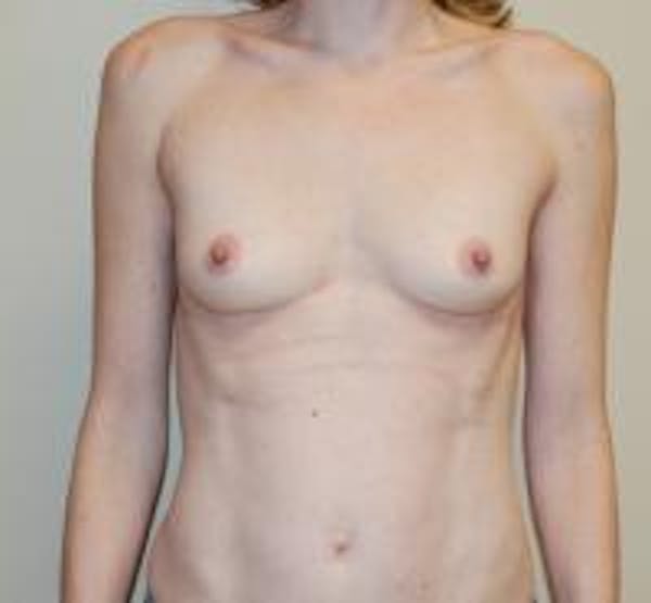 Breast Augmentation Gallery - Patient 22391256 - Image 1