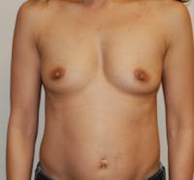 Breast Augmentation Before & After Gallery - Patient 22391257 - Image 1