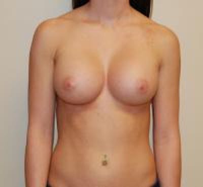 Breast Augmentation Before & After Gallery - Patient 22391259 - Image 2