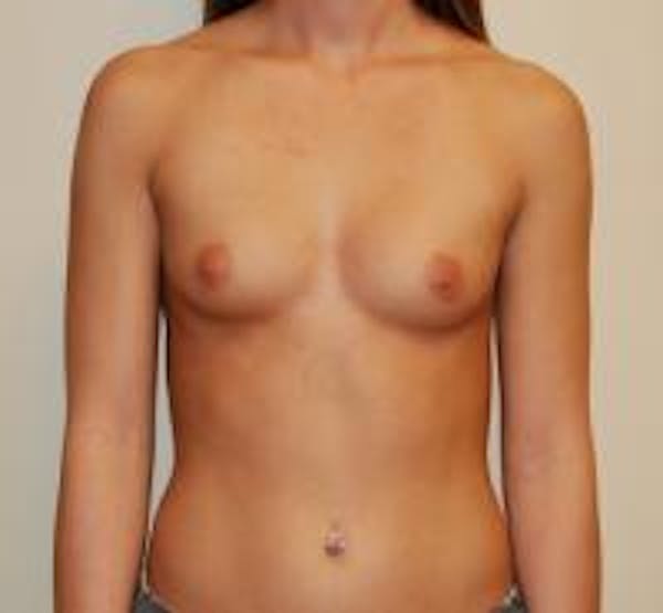 Breast Augmentation Before & After Gallery - Patient 22391259 - Image 1