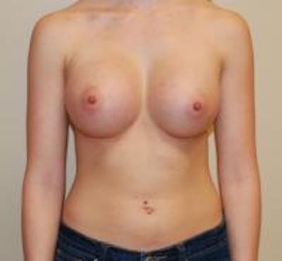 Breast Augmentation Before & After Gallery - Patient 22391260 - Image 2