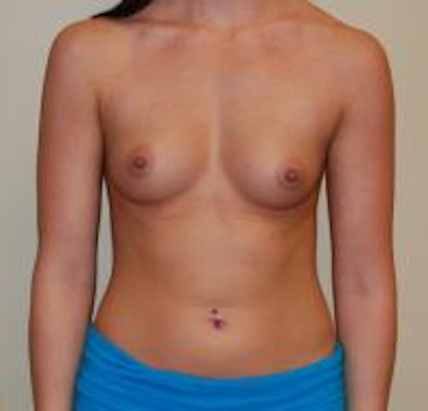 Breast Augmentation Before & After Gallery - Patient 22391260 - Image 1