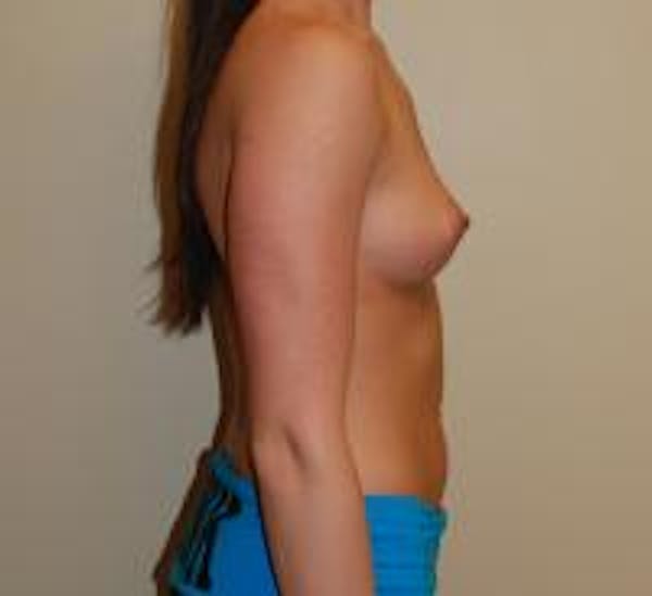 Breast Augmentation Before & After Gallery - Patient 22391260 - Image 3