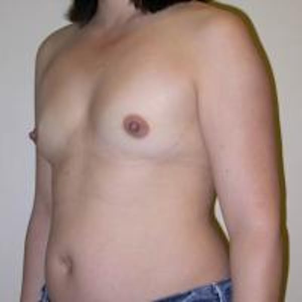 Breast Augmentation Before & After Gallery - Patient 22391262 - Image 1