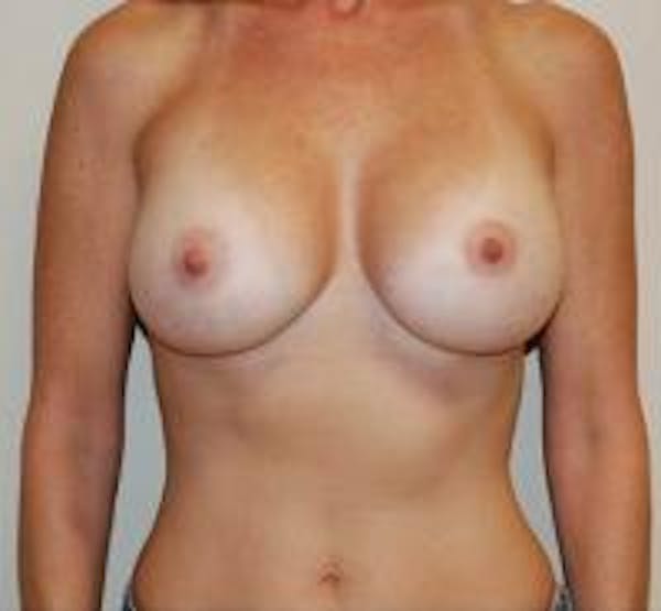 Breast Augmentation Before & After Gallery - Patient 22391263 - Image 2