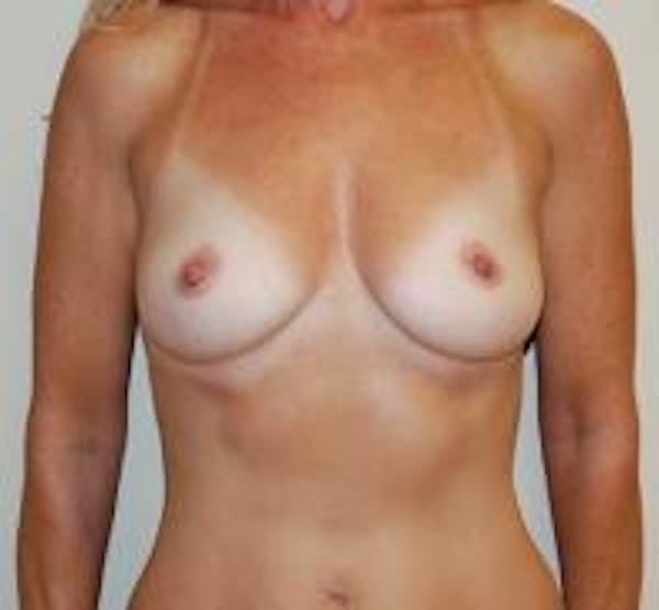 Breast Augmentation Before & After Gallery - Patient 22391263 - Image 1