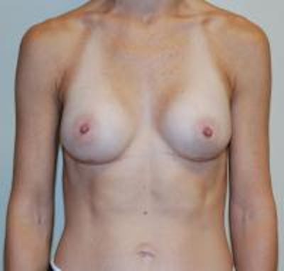 Breast Augmentation Before & After Gallery - Patient 22391264 - Image 2