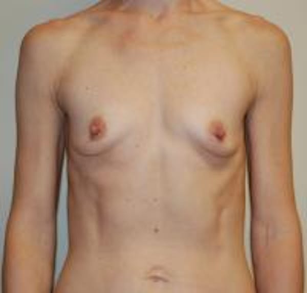 Breast Augmentation Before & After Gallery - Patient 22391264 - Image 1