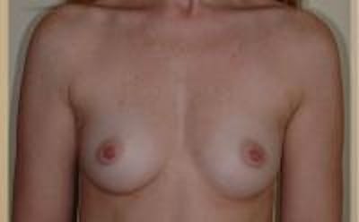 Breast Augmentation Before & After Gallery - Patient 22391265 - Image 1