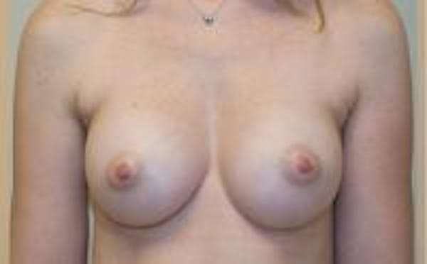 Breast Augmentation Before & After Gallery - Patient 22391265 - Image 2