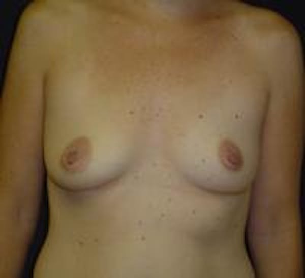 Breast Augmentation Before & After Gallery - Patient 22391268 - Image 1