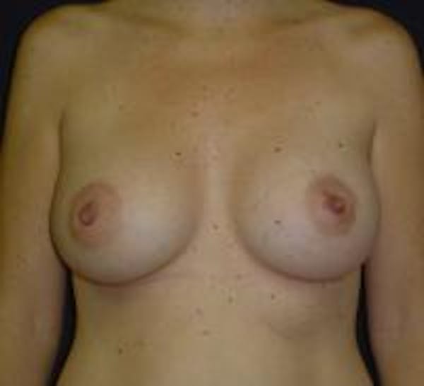 Breast Augmentation Before & After Gallery - Patient 22391268 - Image 2