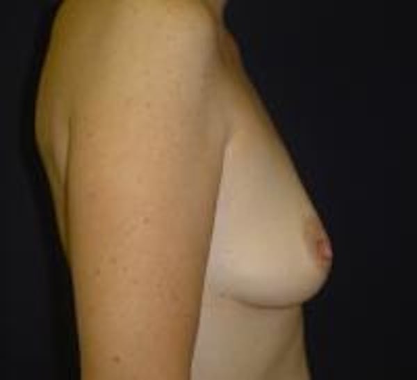Breast Augmentation Before & After Gallery - Patient 22391268 - Image 3