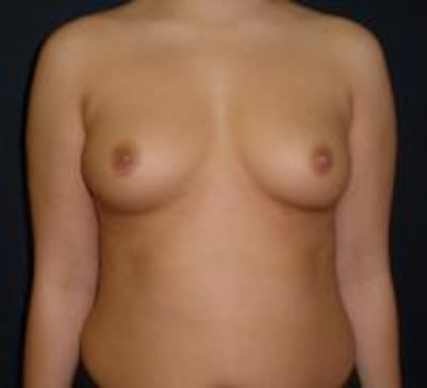 Breast Augmentation Before & After Gallery - Patient 22391269 - Image 1