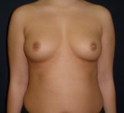 Breast Augmentation Before & After Gallery - Patient 22391269 - Image 1