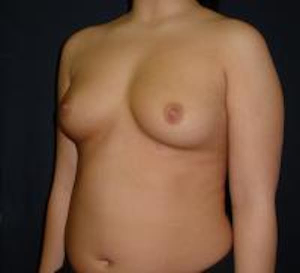 Breast Augmentation Before & After Gallery - Patient 22391269 - Image 3