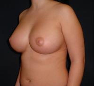 Breast Augmentation Before & After Gallery - Patient 22391269 - Image 4