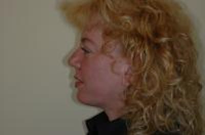 Chin Augmentation Before & After Gallery - Patient 22397094 - Image 6