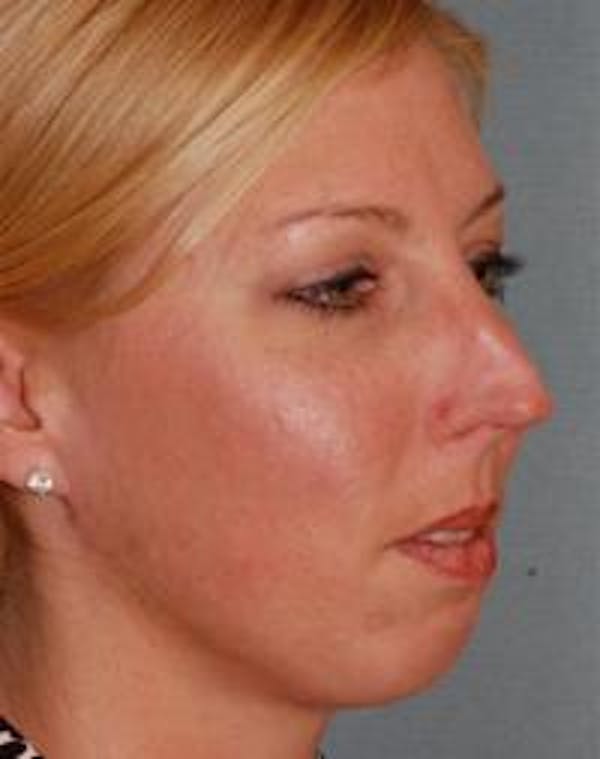 Chin Augmentation Before & After Gallery - Patient 22397095 - Image 3