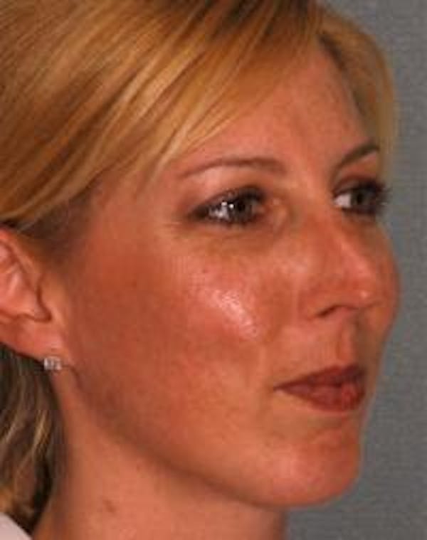 Chin Augmentation Before & After Gallery - Patient 22397095 - Image 4