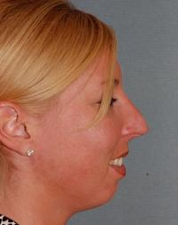 Chin Augmentation Before & After Gallery - Patient 22397095 - Image 5