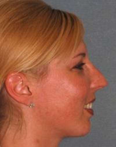 Chin Augmentation Before & After Gallery - Patient 22397095 - Image 6