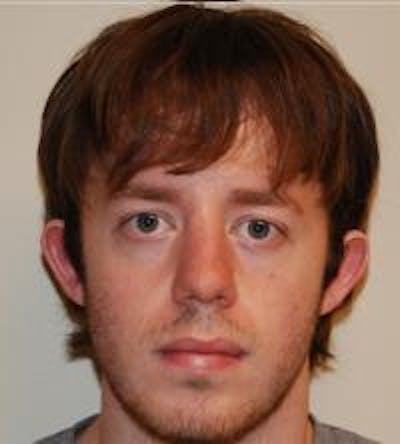 Ear Surgery Before & After Gallery - Patient 22397109 - Image 1