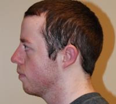 Ear Surgery Before & After Gallery - Patient 22397109 - Image 4