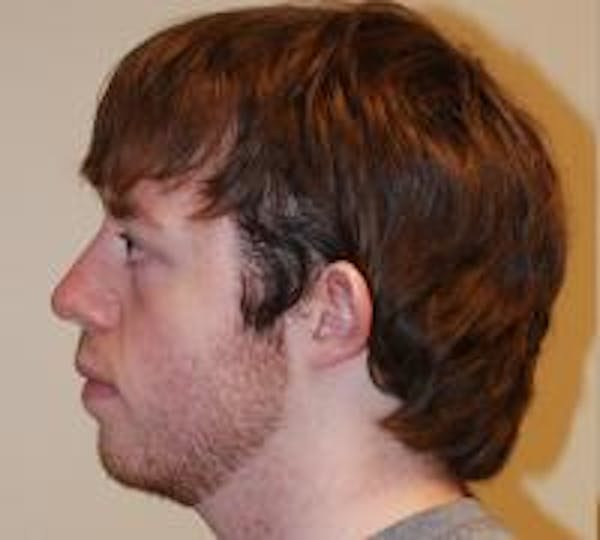 Ear Surgery Before & After Gallery - Patient 22397109 - Image 3