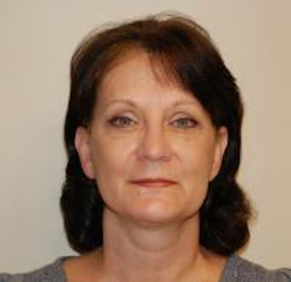 Facelift Before & After Gallery - Patient 22397133 - Image 2