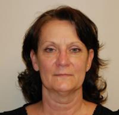 Facelift Before & After Gallery - Patient 22397133 - Image 1