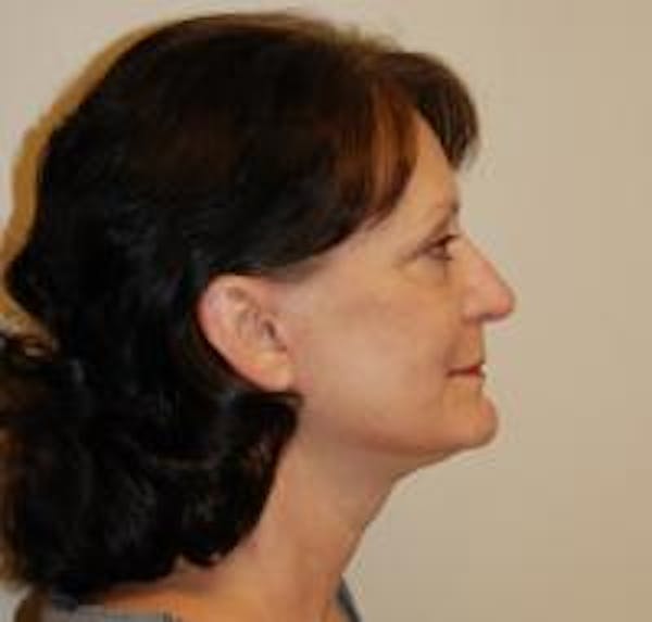 Facelift Before & After Gallery - Patient 22397133 - Image 4