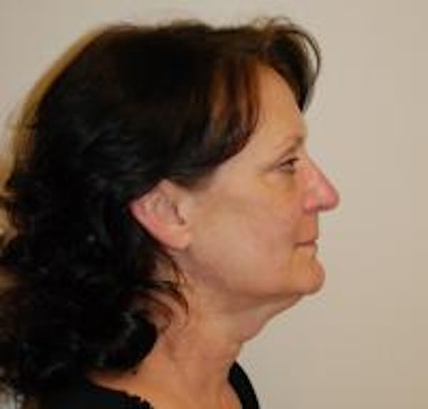 Facelift Before & After Gallery - Patient 22397133 - Image 3