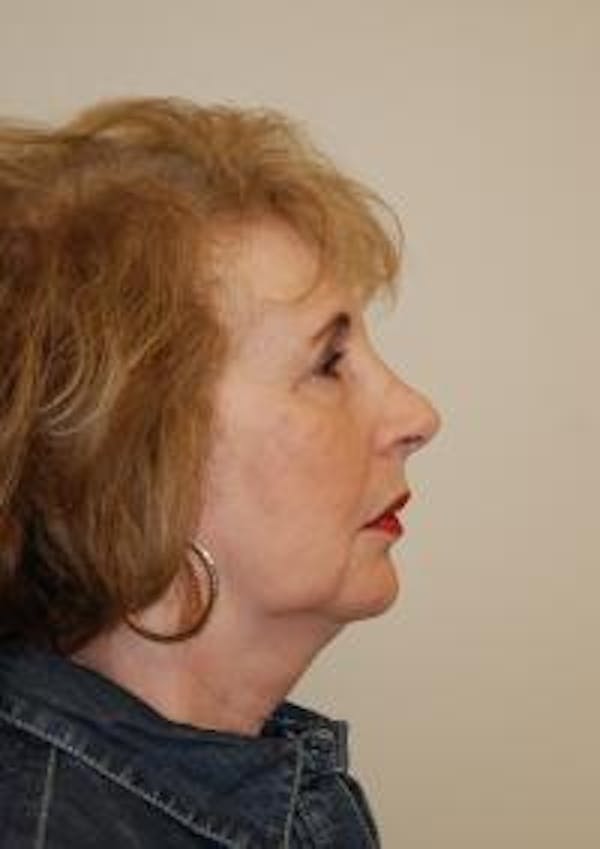 Facelift Before & After Gallery - Patient 22397134 - Image 5