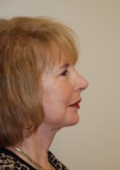 Facelift Before & After Gallery - Patient 22397134 - Image 6