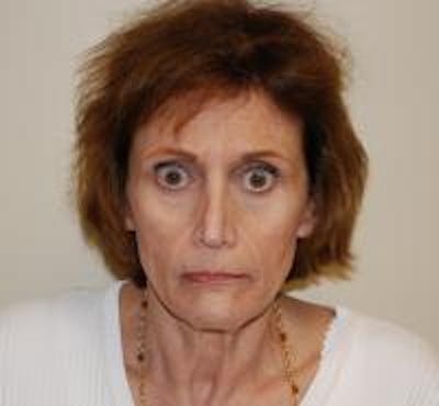 Facelift Before & After Gallery - Patient 22397135 - Image 1