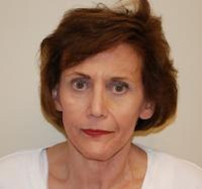 Facelift Before & After Gallery - Patient 22397135 - Image 2